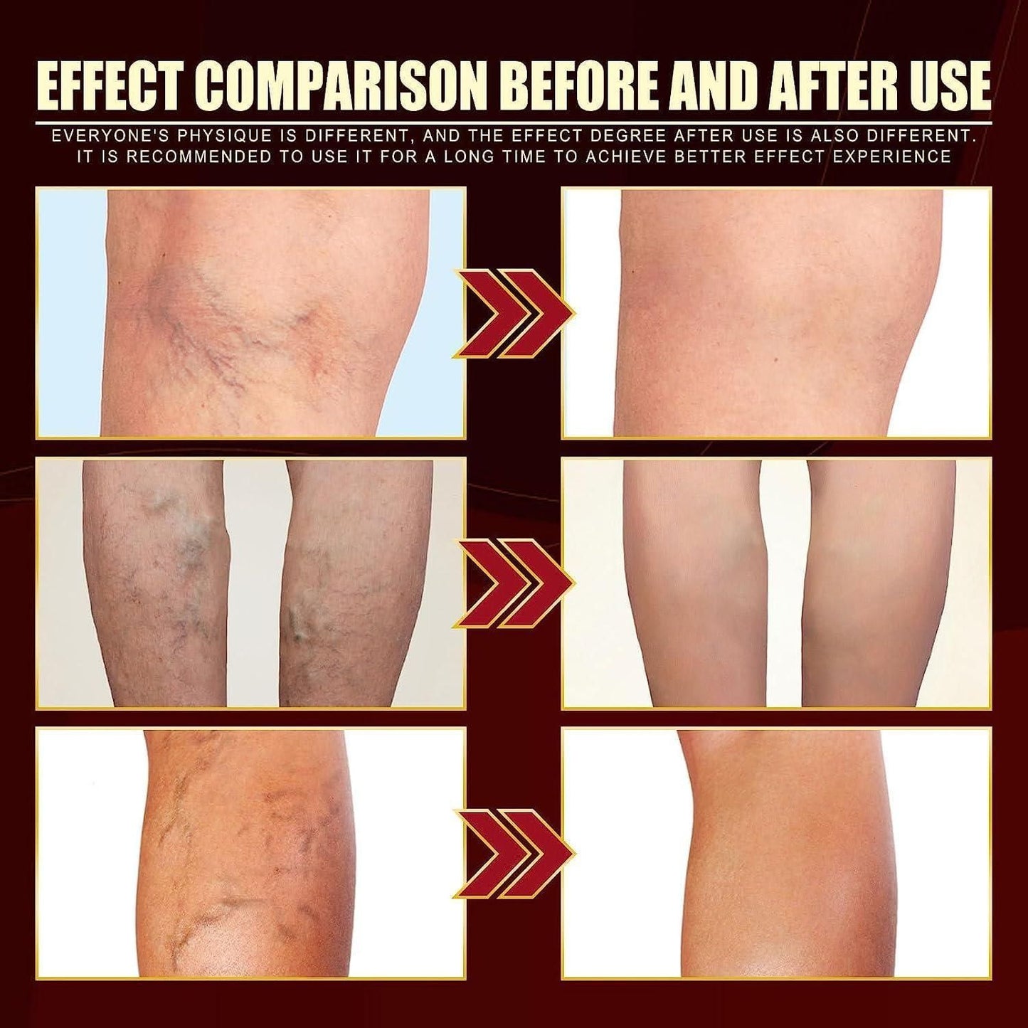 Vein Healing Varicose Veins Treatment Spray Pack of 1