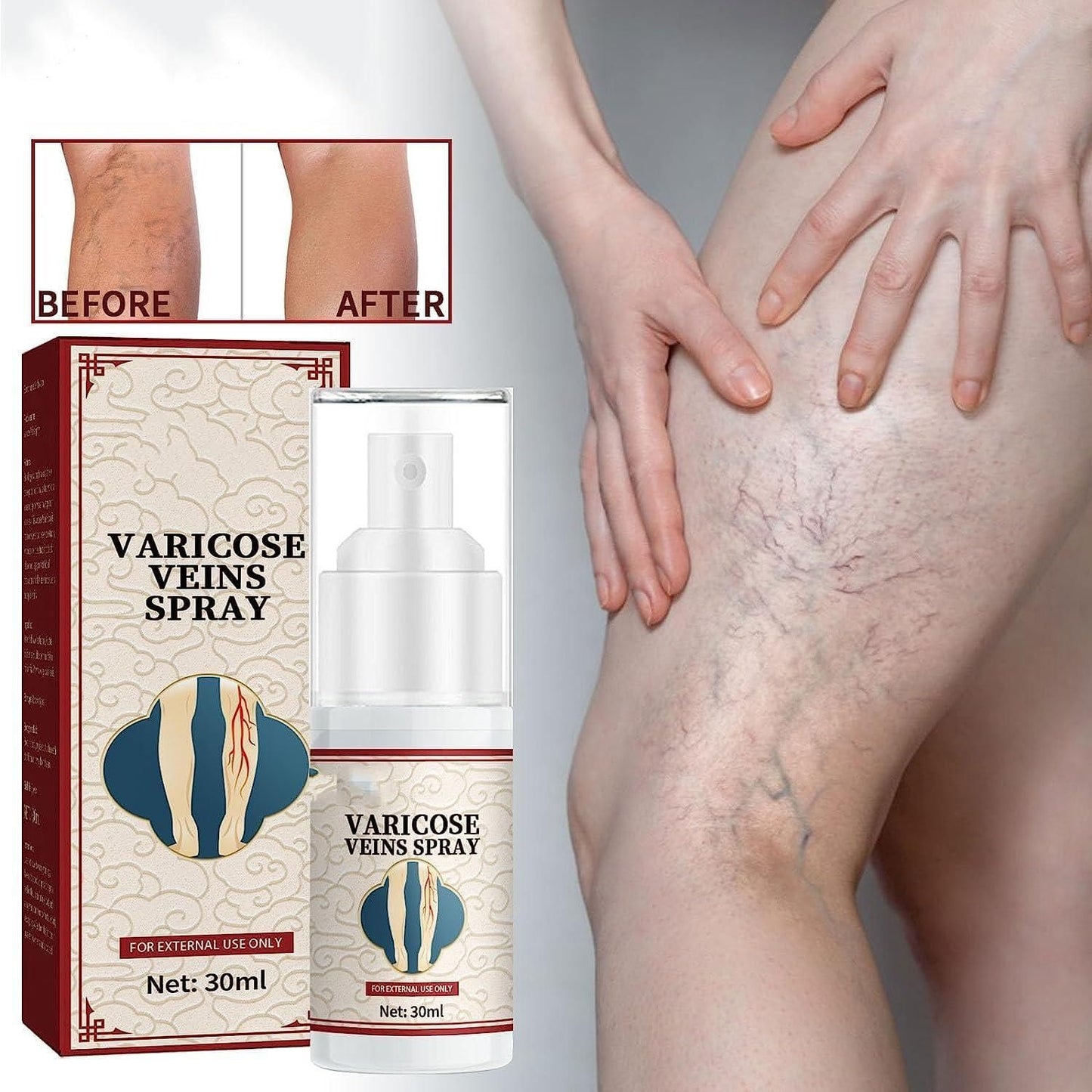 Vein Healing Varicose Veins Treatment Spray Pack of 1